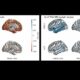 La exposición a la contaminación atmosférica se asocia con cambios cerebrales en regiones vulnerables al alzhéimer